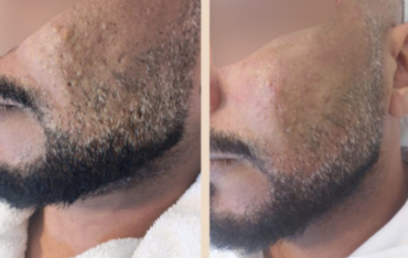 Beard patch treatment Gachibowli