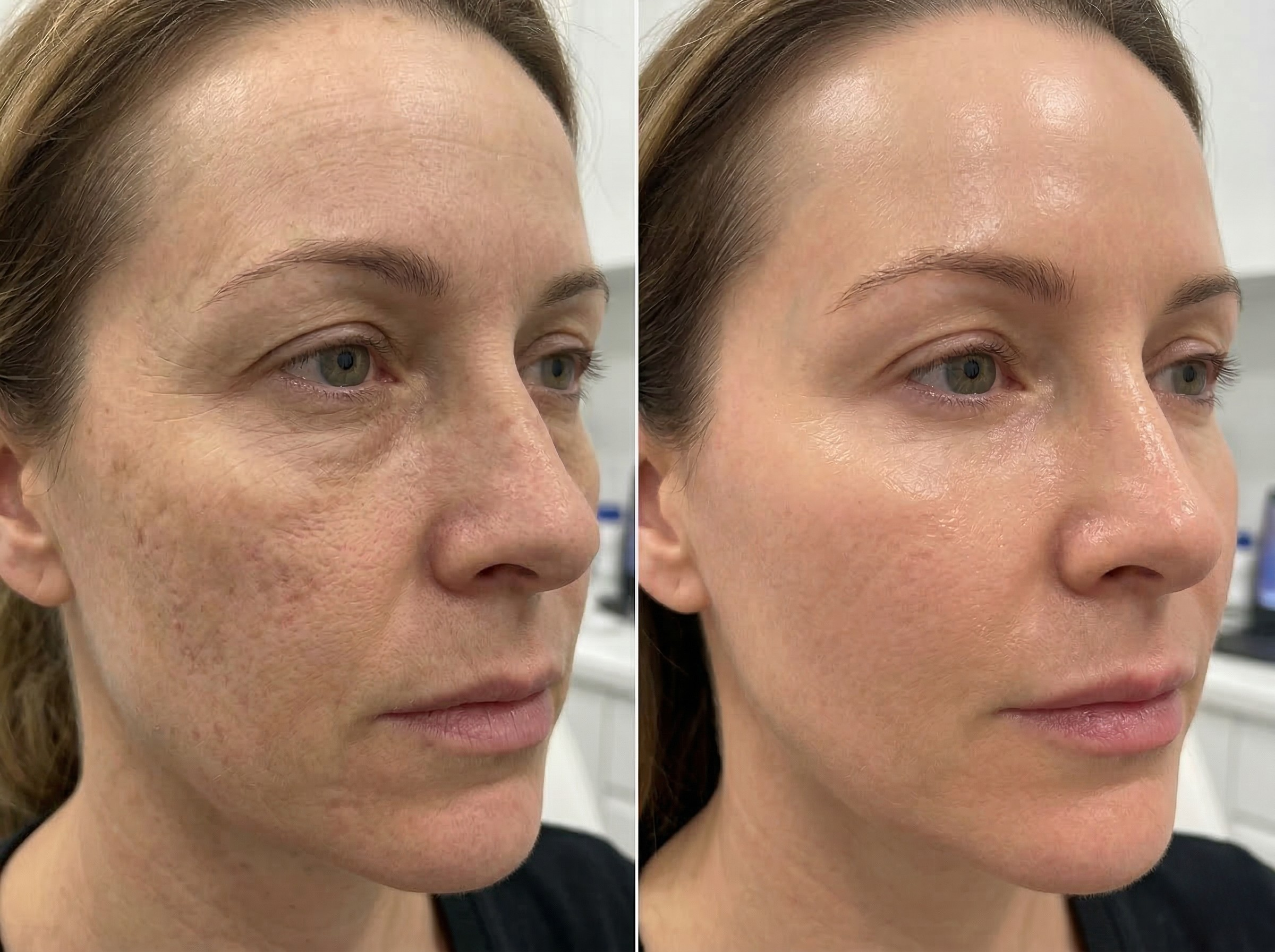 Facial PRP and Under Eye PRP treatment at Rida Radiance Hyderabad