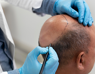 FUE / FUT Hair Transplant in Gachibowli