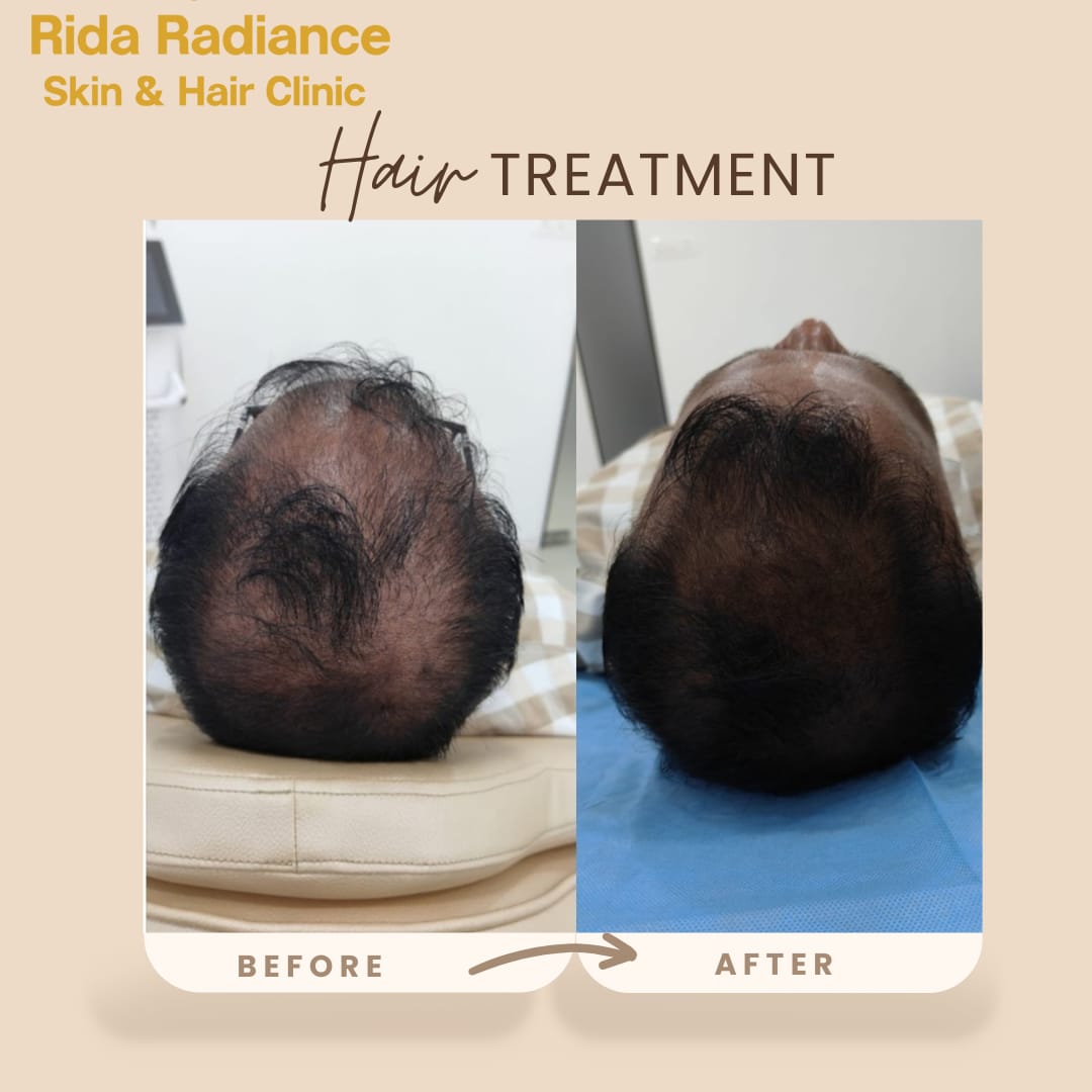 Hair Fall Control & Regrowth in Gachibowli