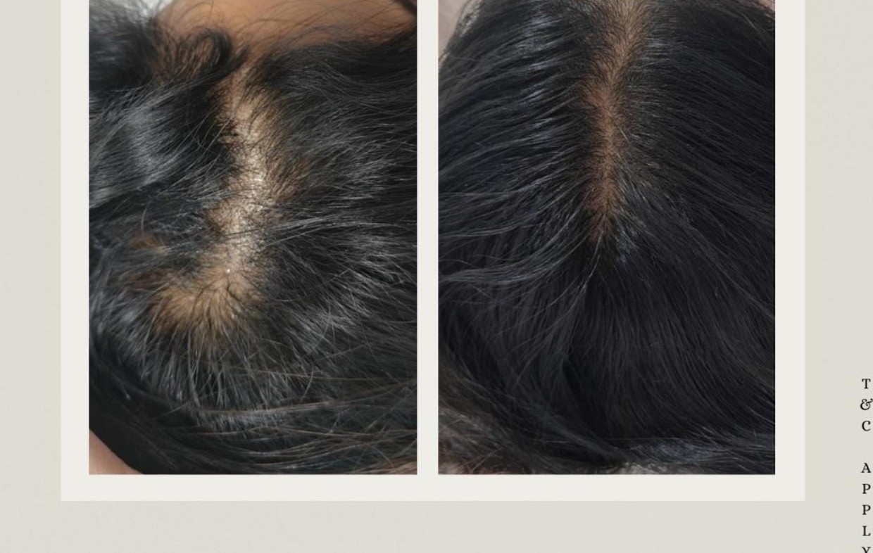 Hairline restoration treatment in Gachibowli